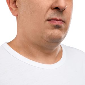 Endolift para la papada en Clinica Miramar en Benissa, Calpe Moraira y alrededores