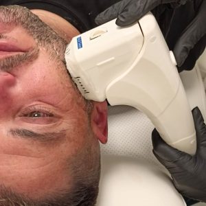 Rostro rejuvenecido tras tratamiento HIFU lifting facial en Clínica Miramar, Benissa