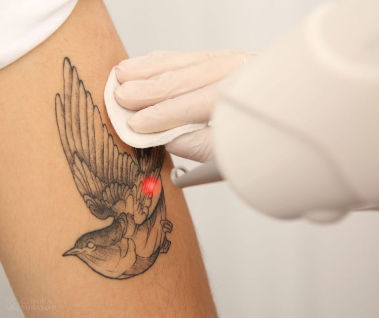 Eliminación de tatuajes con láser YAG Q-Switched en Clínica Miramar Benissa Moraira Calpe